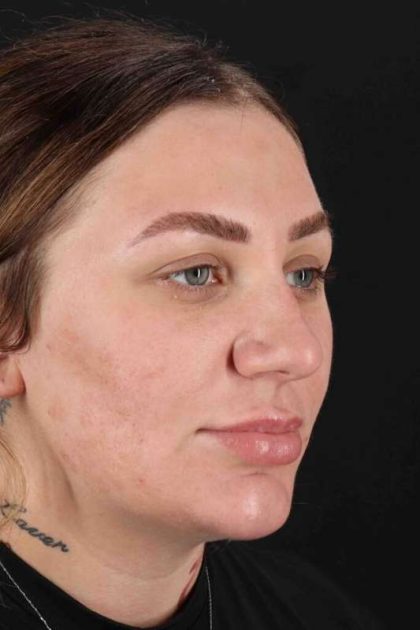 Rhinoplasty Before & After Patient #3104