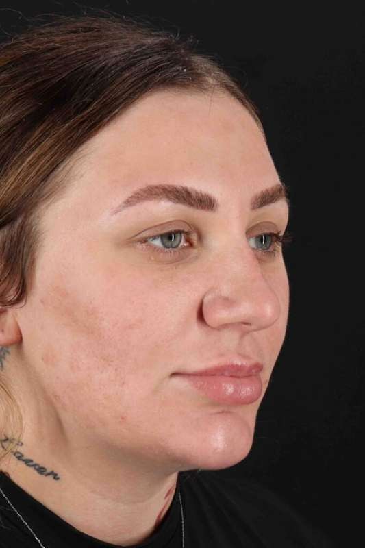 Rhinoplasty Before & After Patient #3104