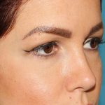 Browlift Before & After Patient #1384