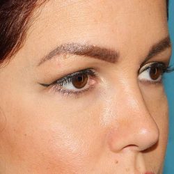 Browlift Before & After Patient #1384