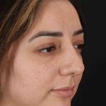 Rhinoplasty Before & After Patient #3115