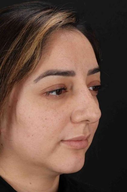 Rhinoplasty Before & After Patient #3115