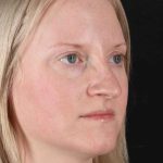 Rhinoplasty Before & After Patient #3126