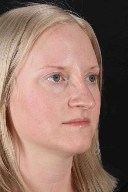 Rhinoplasty Before & After Patient #3126