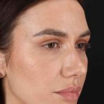 Rhinoplasty Before & After Patient #3137