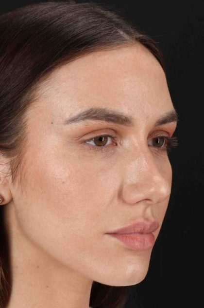 Rhinoplasty Before & After Patient #3137