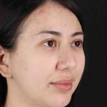 Rhinoplasty Before & After Patient #3159