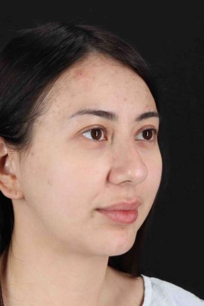 Rhinoplasty Before & After Patient #3159