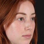 Rhinoplasty Before & After Patient #3170