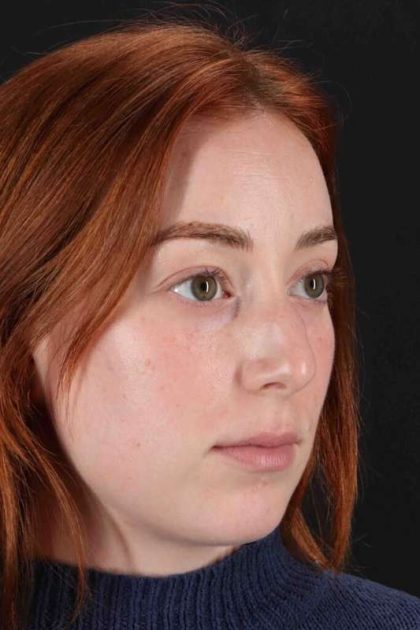Rhinoplasty Before & After Patient #3170