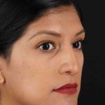 Rhinoplasty Before & After Patient #3181
