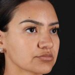 Rhinoplasty Before & After Patient #3192