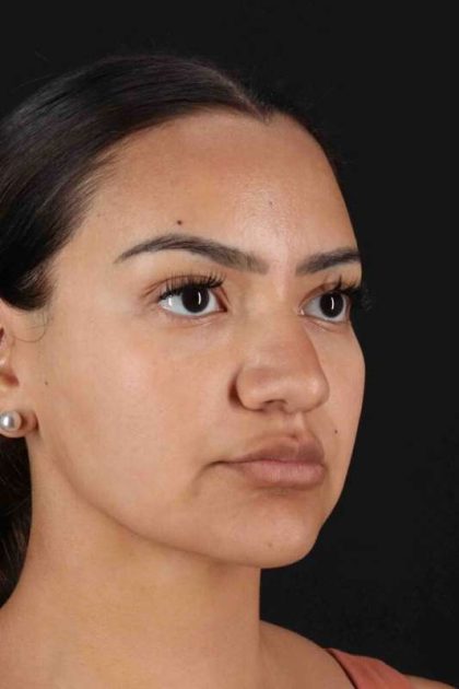 Rhinoplasty Before & After Patient #3192