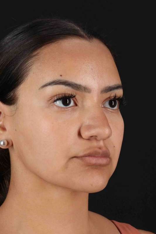 Rhinoplasty Before & After Patient #3192
