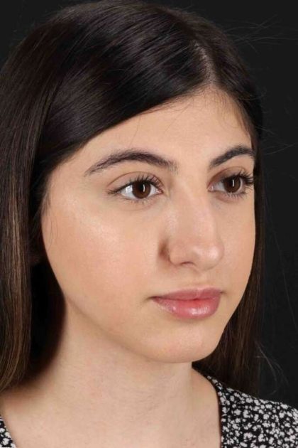 Rhinoplasty Before & After Patient #3214