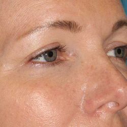 Browlift Before & After Patient #1391