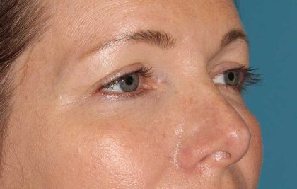 Browlift Before & After Patient #1391