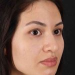 Rhinoplasty Before & After Patient #3236