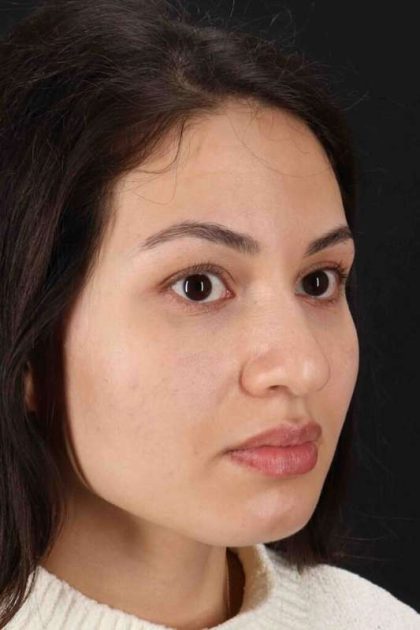Rhinoplasty Before & After Patient #3236