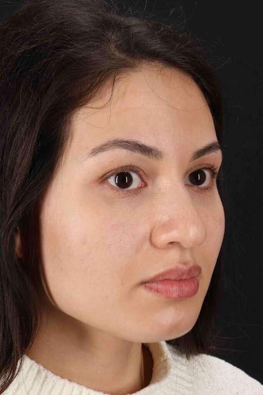 Rhinoplasty Before & After Patient #3236