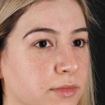 Rhinoplasty Before & After Patient #3247