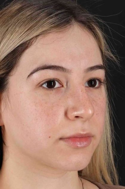 Rhinoplasty Before & After Patient #3247