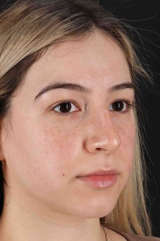 Rhinoplasty Before & After Patient #3247
