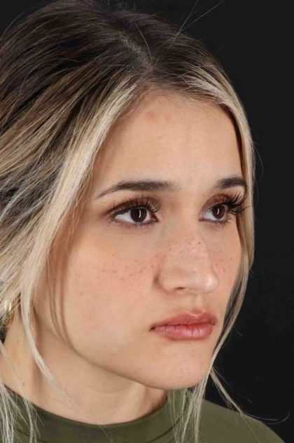 Rhinoplasty Before & After Patient #3258