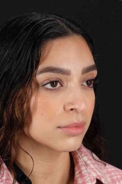 Rhinoplasty Before & After Patient #3269