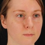 Rhinoplasty Before & After Patient #3280