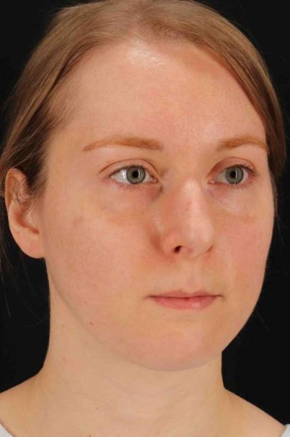 Rhinoplasty Before & After Patient #3280
