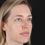 Rhinoplasty Before & After Patient #3291