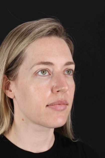Rhinoplasty Before & After Patient #3291
