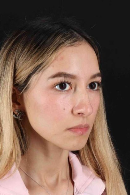 Rhinoplasty Before & After Patient #3302