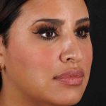 Rhinoplasty Before & After Patient #3324