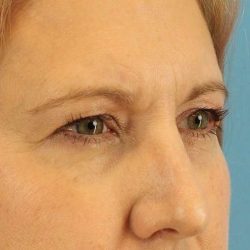 Browlift Before & After Patient #1402