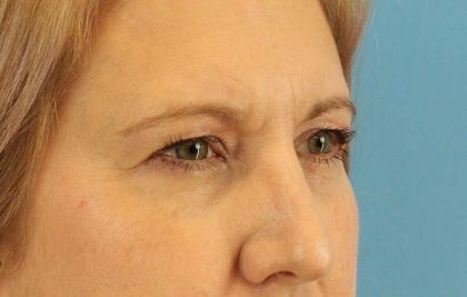 Browlift Before & After Patient #1402