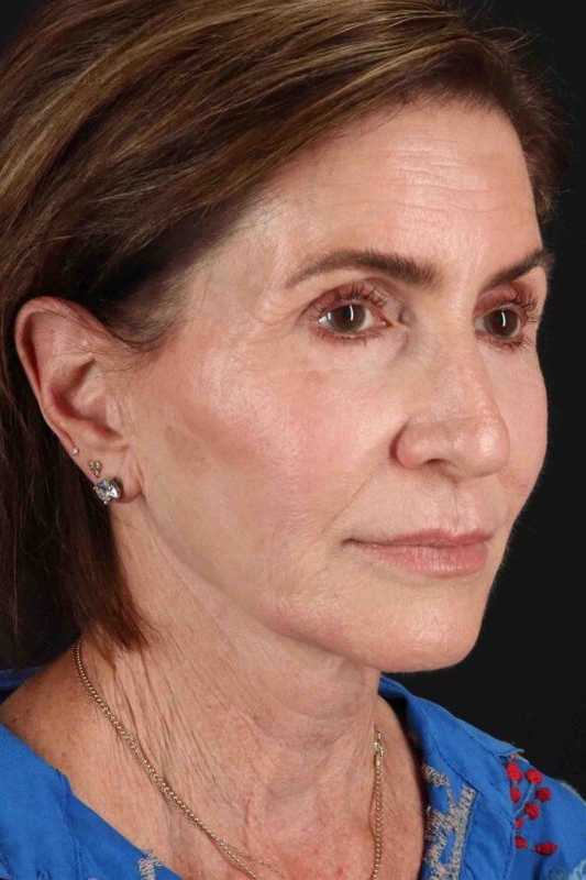 Co2 Laser Before & After Patient #3346