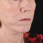 Submental Liposuction Before & After Patient #3401