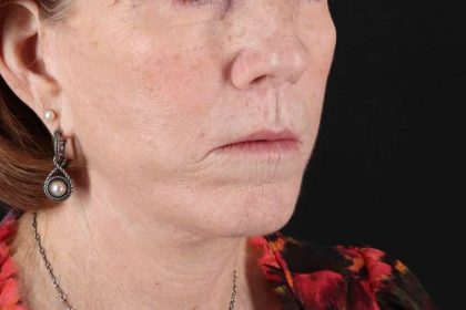 Submental Liposuction Before & After Patient #3401