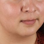 Submental Liposuction Before & After Patient #3412