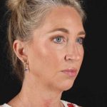Upper Blepharoplasty Before & After Patient #3434