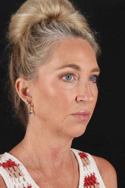 Upper Blepharoplasty Before & After Patient #3434