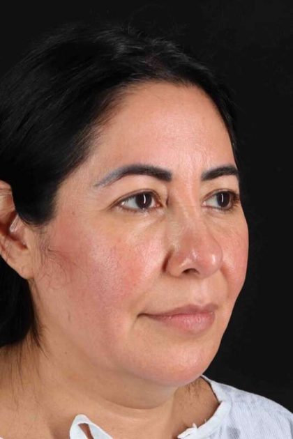 Upper Blepharoplasty Before & After Patient #3456