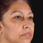Upper Blepharoplasty Before & After Patient #3467