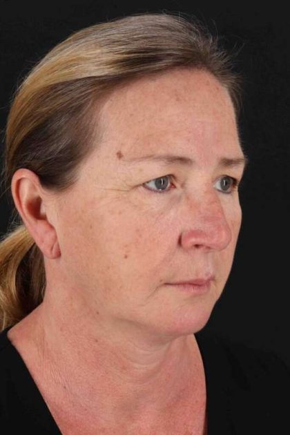 Upper Blepharoplasty Before & After Patient #3478