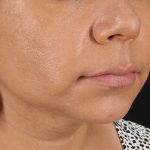 Facelift Before & After Patient #3555