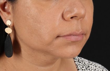 Facelift Before & After Patient #3555