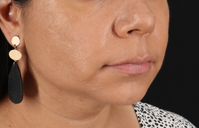 Facelift Before & After Patient #3555