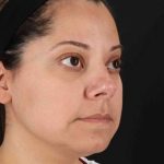 Buccal Fat Pad Before & After Patient #1436